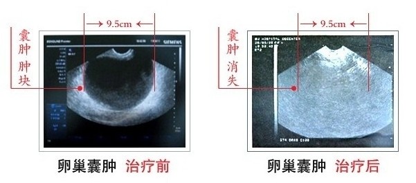 卵巢囊肿治疗前后